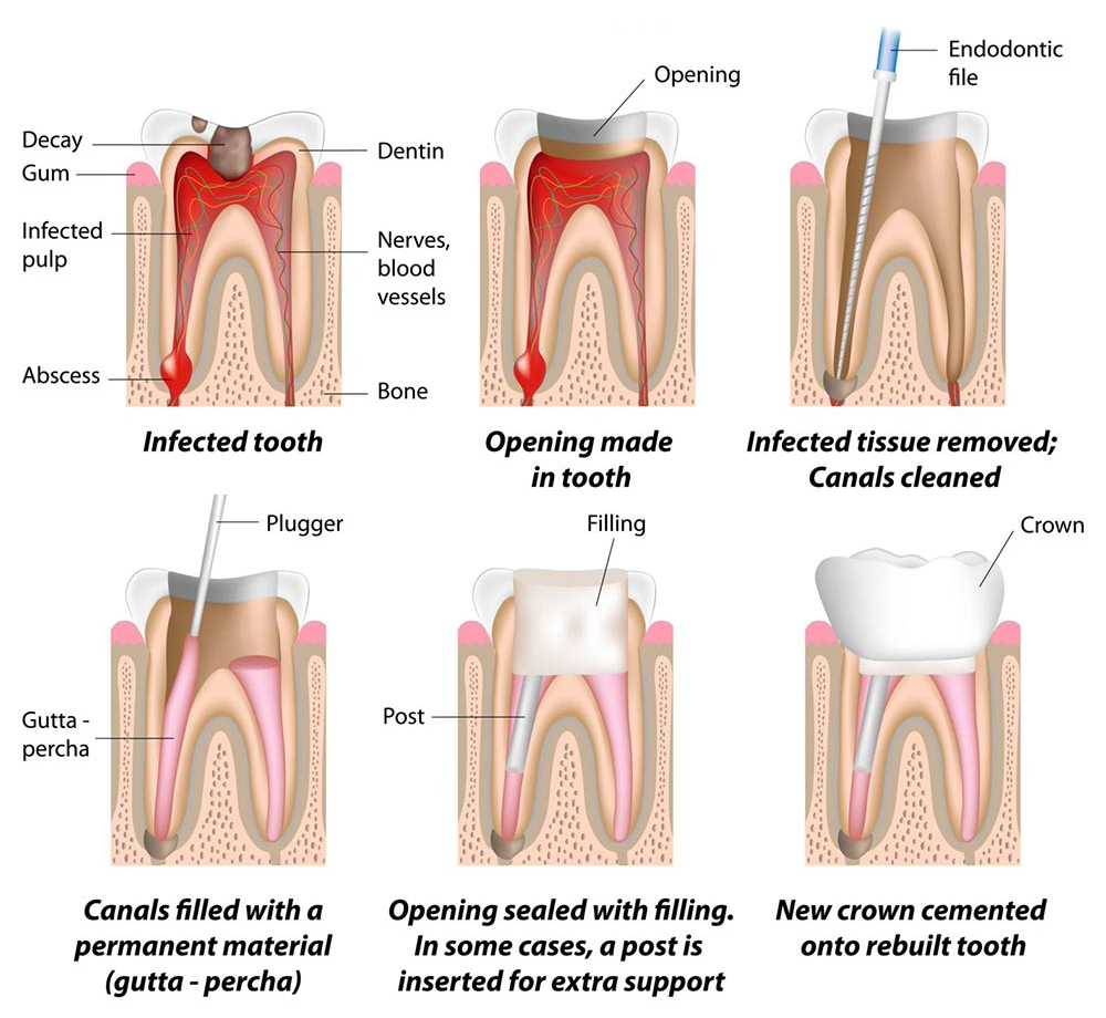 Root Canal Process in steps at Zen Dental Studio